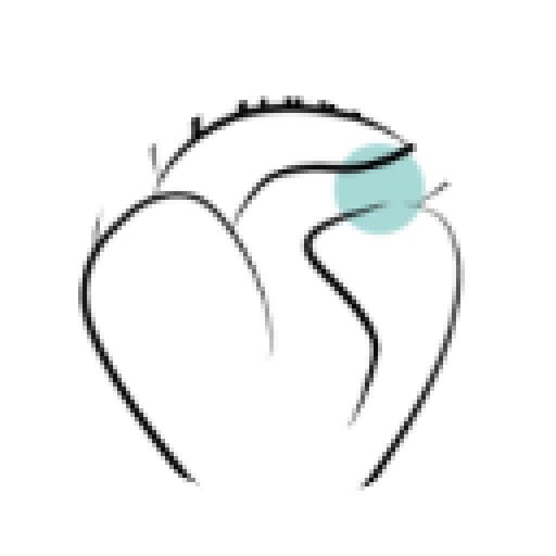 Pulmonary artery with fibrosis.